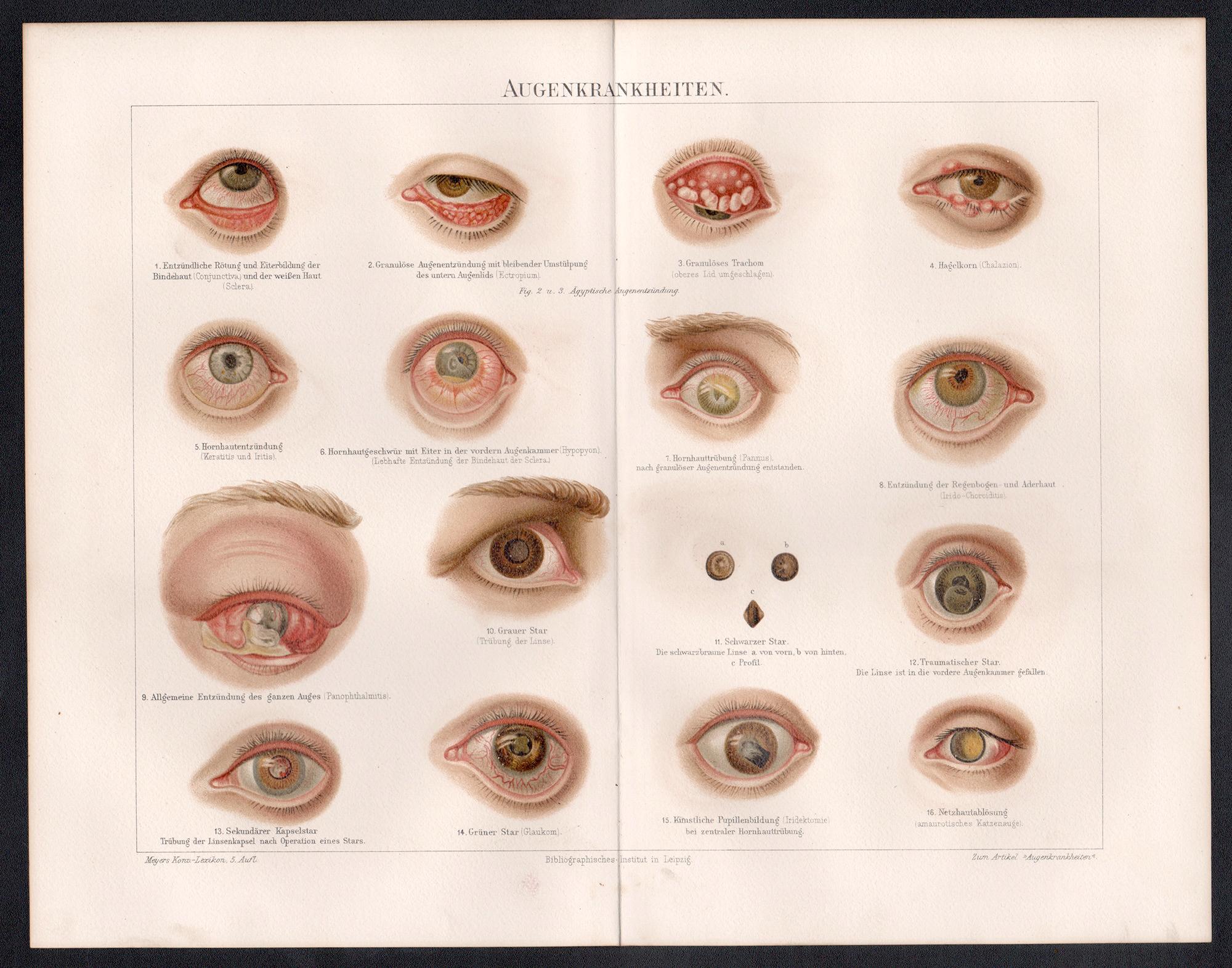 Enfermedades oculares, impresión cromolitográfica médica antigua alemana - Print de Unknown