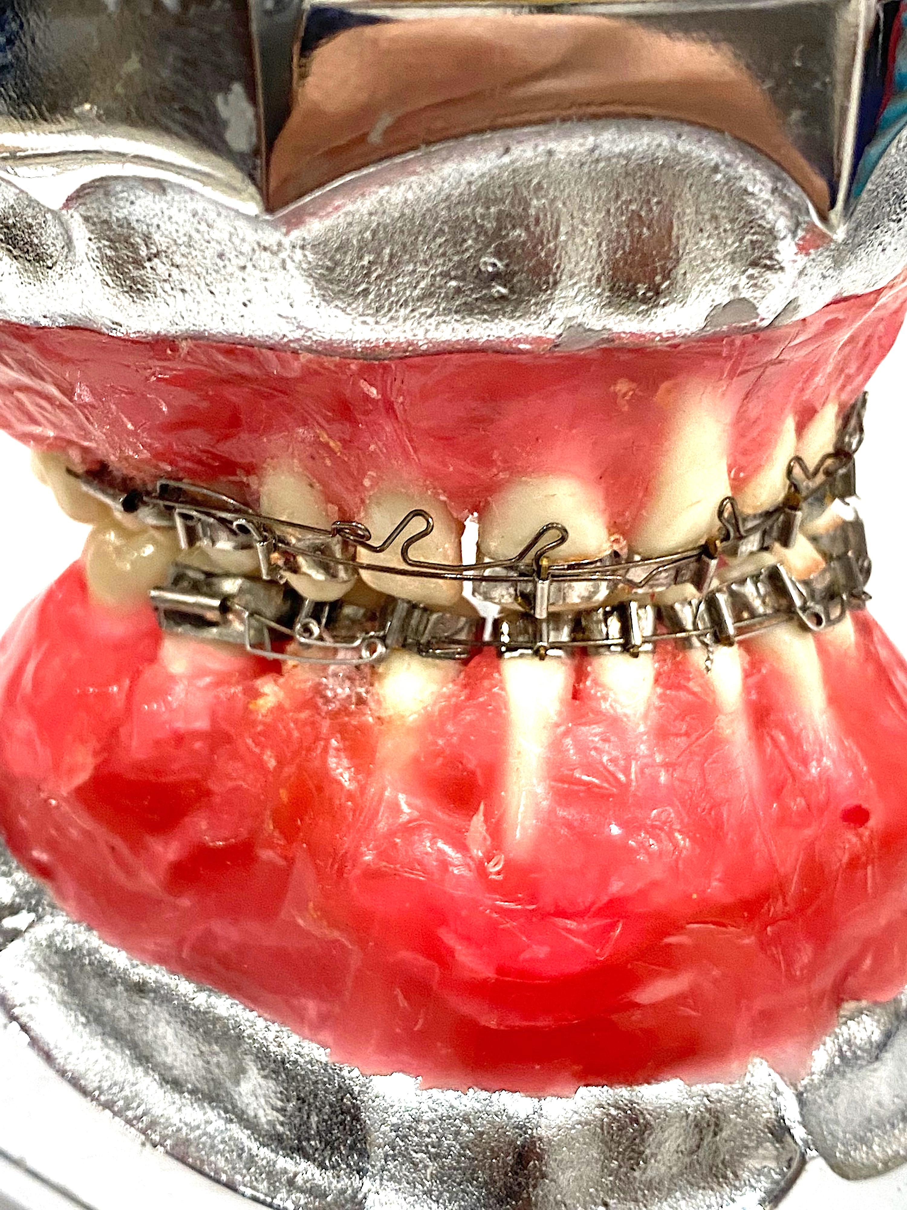 A vintage 1960/70s teaching dental model of a mouth with braces by noted company Columbia Dentoforms. Columbia Dentoforms has been making teaching models for over 100 years and known in the industry. The resin model mouth of gums and teeth with